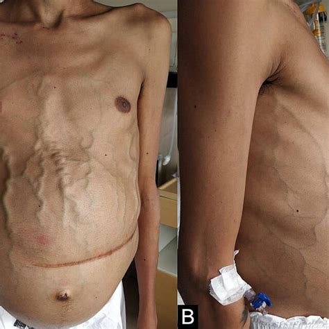 Pre-TIPS procedure. (A) Anterior view of the abdomen showing distended... | Download Scientific ...