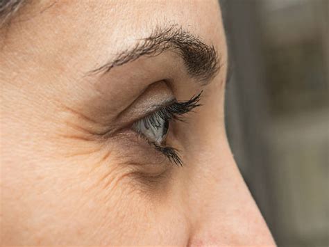 How To Remove Wrinkles On The Outer Corner Of The Eyes? - Boldsky.com