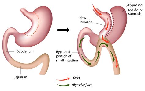 Roux En Y Procedure and All about it | Healing Consulting Turkey