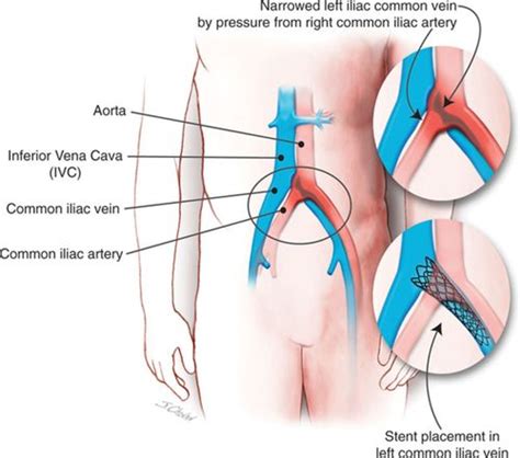 May Thurner Syndrome | Treatment of Iliac Vein Compression Syndrome