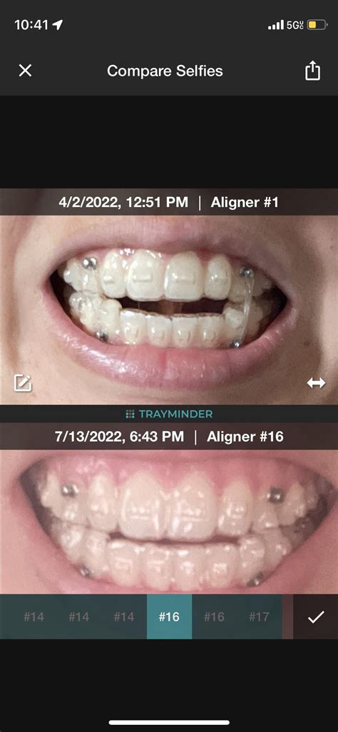 Open Bite Progress! : r/Invisalign