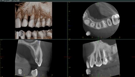 Internal Resorption Gaylord MI, Otsego Endodontics