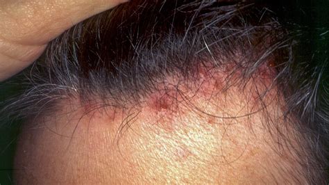 Red Scalp And Hair Loss Bumps On The Scalp Causes Symptoms And | Images and Photos finder