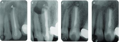 (A) A preoperative radiograph of a maxillary canine with a... | Download Scientific Diagram