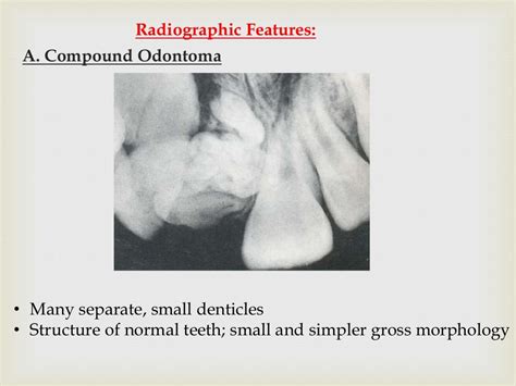 Tumor of oral cavity