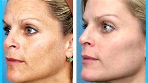 Clear And Brilliant Laser Treatment - Treat Choices