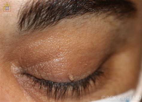 Eyelid Skin Tags: Causes And Treatment All About Vision, 46% OFF