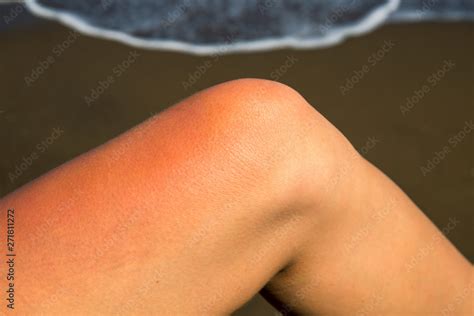 Woman leg with red sunburn skin on seaside background. Sunburned skin redness and irritation ...