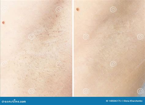 Waxing Cosmetic Depilation Procedure Results before after Armpit Stock Image - Image of depilate ...