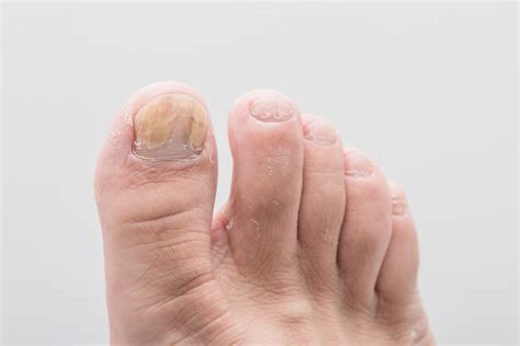 Toenail Fungus: Causes, Symptoms, and Treatment