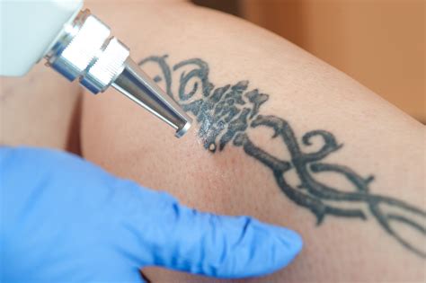 11 Things You Should Know About Laser Tattoo Removal - Alma Lasers