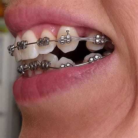 bloggingforfun6395: Metal Braces On Bottom Teeth