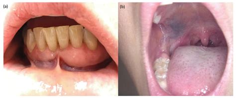 Imatinib Side Effects: The Risk of Oral Tooth Damage - Internet Club of ...