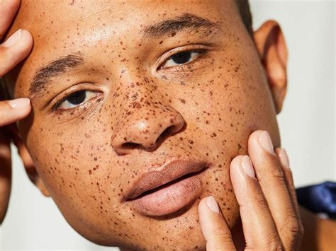 How to Tell If You Have a Mole, Birthmark or Freckle | Skincare.com