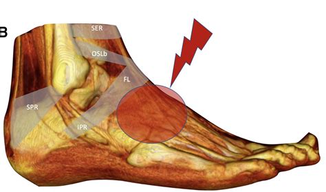 Extensor Tendonitis: Foot Tendonitis Explained - Dr. Justin Dean