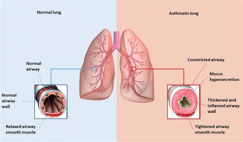 Asthma Lungs Compared To Normal Lungs