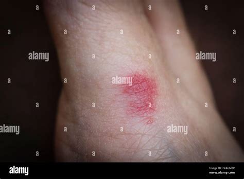 Ant bite on the skin of the foot. Red inflammation from damage to human skin Stock Photo - Alamy