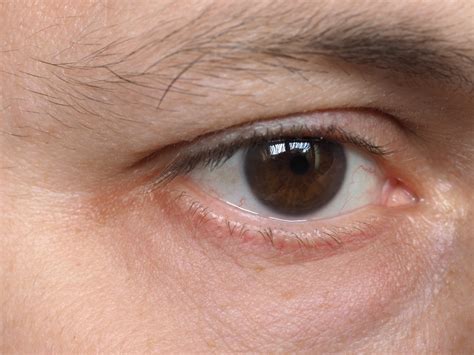 Lacrimal Surgery — Huw Oliphant Eye Surgery