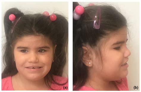 Patient's facial dysmorphic features | Download Scientific Diagram