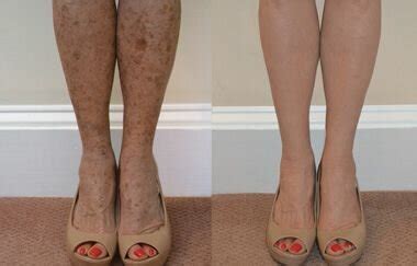 Why do I have brown spots on my Legs? — Physicians Vein Clinics