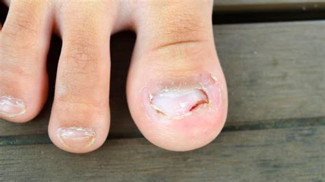 Do You Frequently Get Toenail Fungus? Here's How You Can Prevent It | OnlyMyHealth