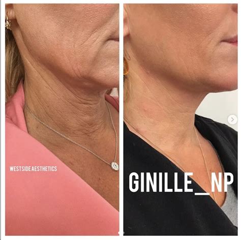 NO SURGERY! Neck lift | Neck lift, Liquid facelift, Non surgical facelift