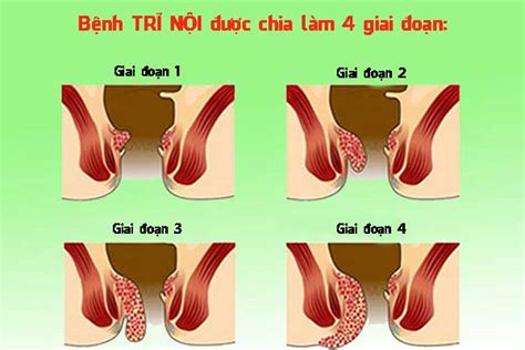 Bệnh Trĩ Ngoại có nguy hiểm không? Nguyên nhân và dấu hiệu của bệnh là gì?