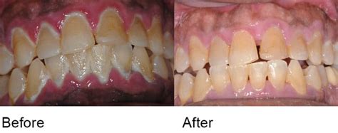 Scaling and Root Planing | Periodontal Procedures