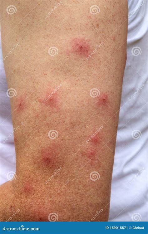 Mosquito Bites Allergy Treatment