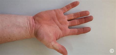 Urticaria Hand