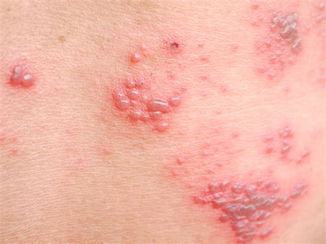 Dermatitis Herpetiformis Blisters