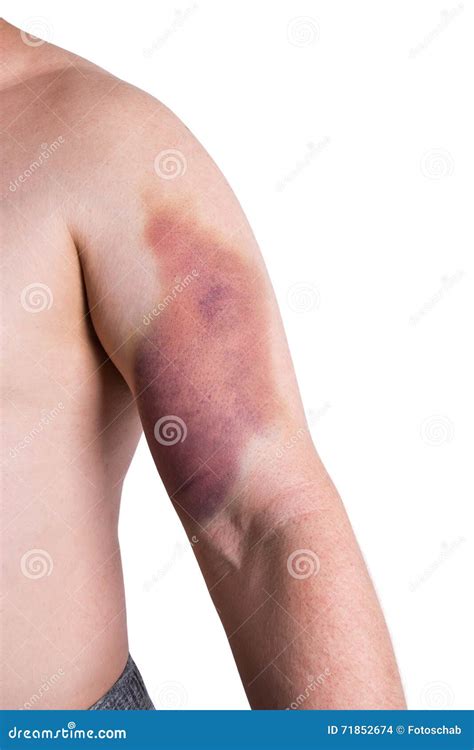 Large Bruise On Human Arm Royalty-Free Stock Photo | CartoonDealer.com #52499445