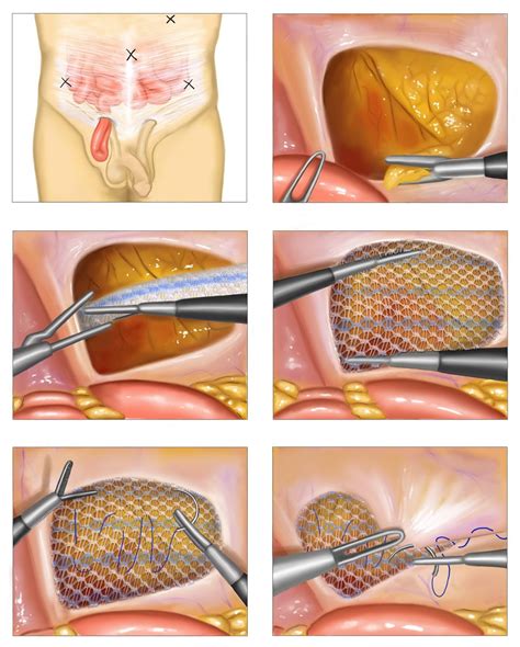 Inguinal Hernia - Pictures