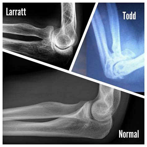 Elbow X-rays: Devon Larratt vs Michael Todd vs normal elbow : armwrestling