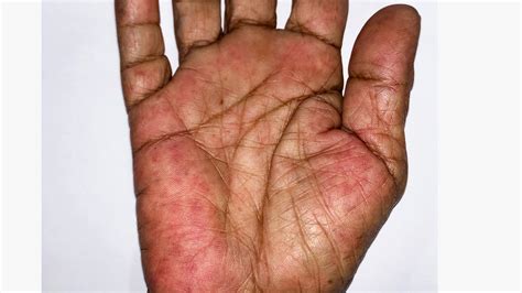 Rheumatoid Arthritis Rashes: Pictures, Symptoms, & Treatments