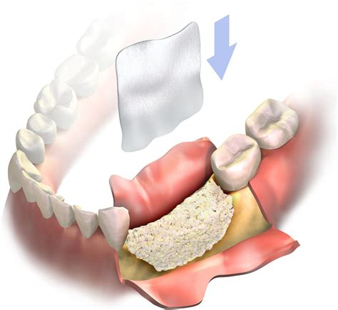 Dental Bone Regeneration - Everything You Need To Know