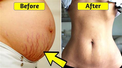 How to Get Rid of Hanging Belly After Pregnancy - YouTube