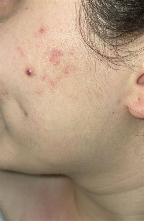 Cystic acne scars help : r/SkincareAddicts