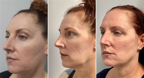 Patients paying $10K for plastic surgery to fix sagging ‘Ozempic face’
