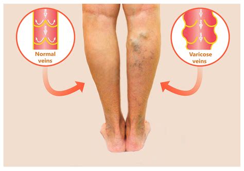 How To Get Rid of Unsightly Hand and Leg Veins — Vein Institute