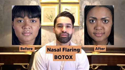 Botox For Nasal Flaring - YouTube