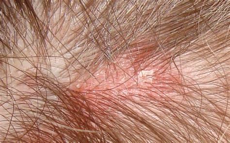 What Are These White Patches On My Scalp - Printable Templates Free