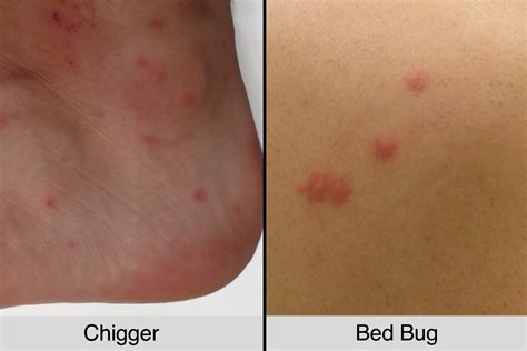 Flea Bites Vs Bed Bug Bites | Renew Physical Therapy