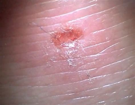 Morgellons Disease - Pictures, Symptoms, Causes, Treatment