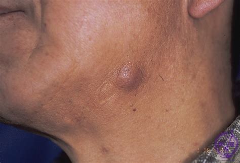 Epidermoid Cysts Epidermal Inclusion Cyst Are Small L - vrogue.co