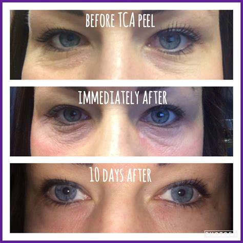 under eye tca peel before and after - mujicafaruolo