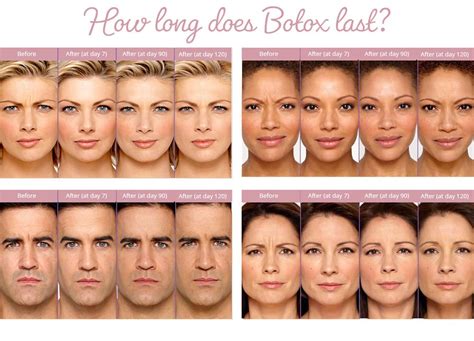 Learn how long Botox lasts & when to touch up - BabyFace MedSpa AZ ...