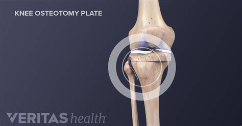 Knee Osteotomy Surgery