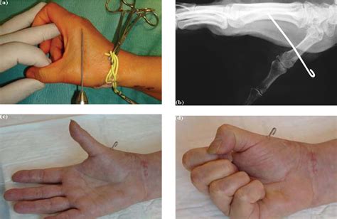 Figure 2.10 from Trapeziometacarpal Joint Arthritis | Semantic Scholar