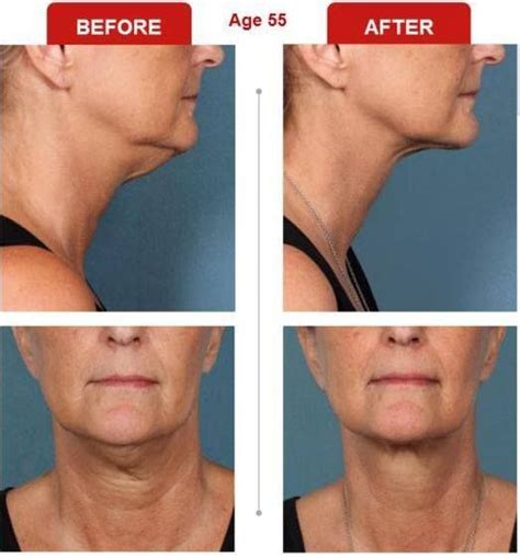 Kybella Before and After photos for Double Chin | Double chin, Kybella, Plastic surgery